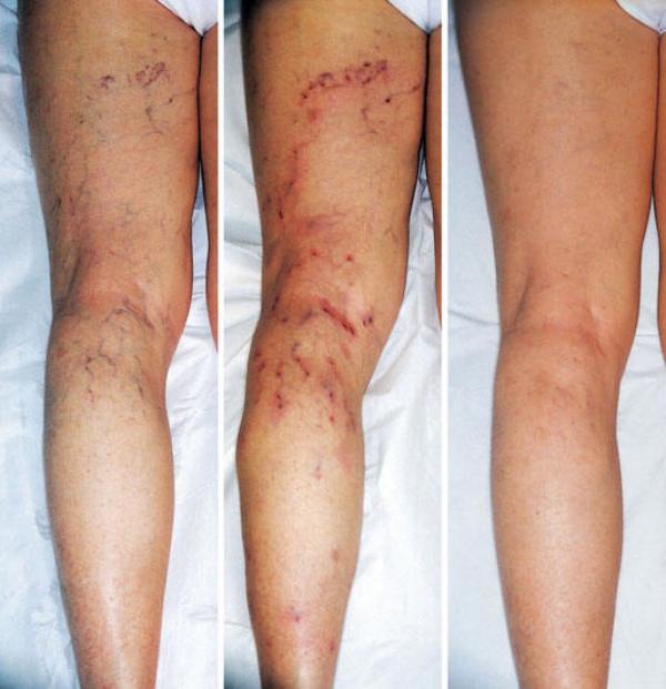 стадии варикоза ног 
