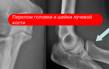 Перелом головки и шейки лучевой кости Перелом головки и шейки лучевой кости