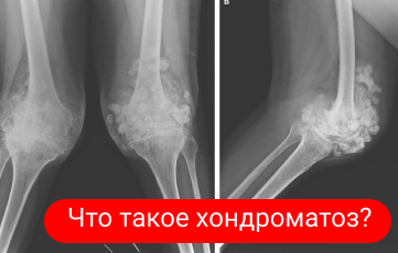 Хондроматоз — что это? Хондроматоз — что это?