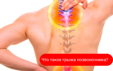 Что такое грыжа позвоночника? Что такое грыжа позвоночника?