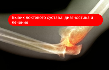 Вывих локтевого сустава — причины и восстановление Вывих локтевого сустава — причины и восстановление
