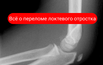 Перелом локтевого отростка. Что это такое? Перелом локтевого отростка. Что это такое?