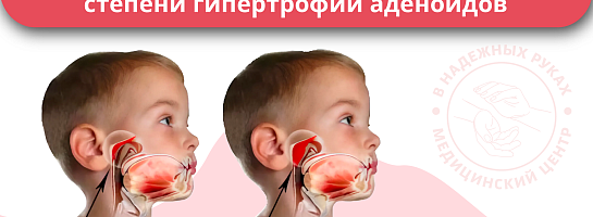 Комплекс исследований для диагностики степени гипертрофии аденоидов Комплекс исследований для диагностики степени гипертрофии аденоидов